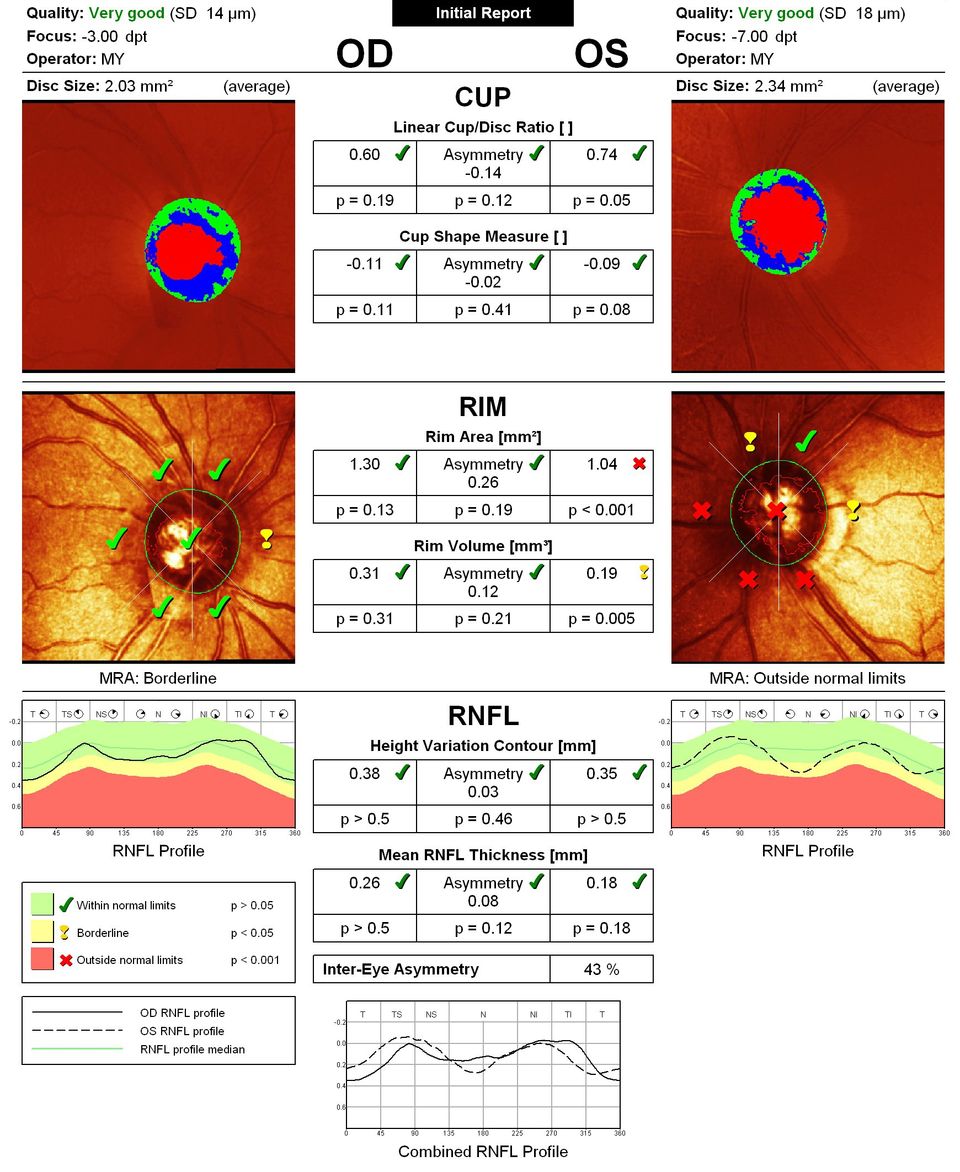 Glaucoma Optic Nerve Imaging Toronto Skouras Eye Cosmetic